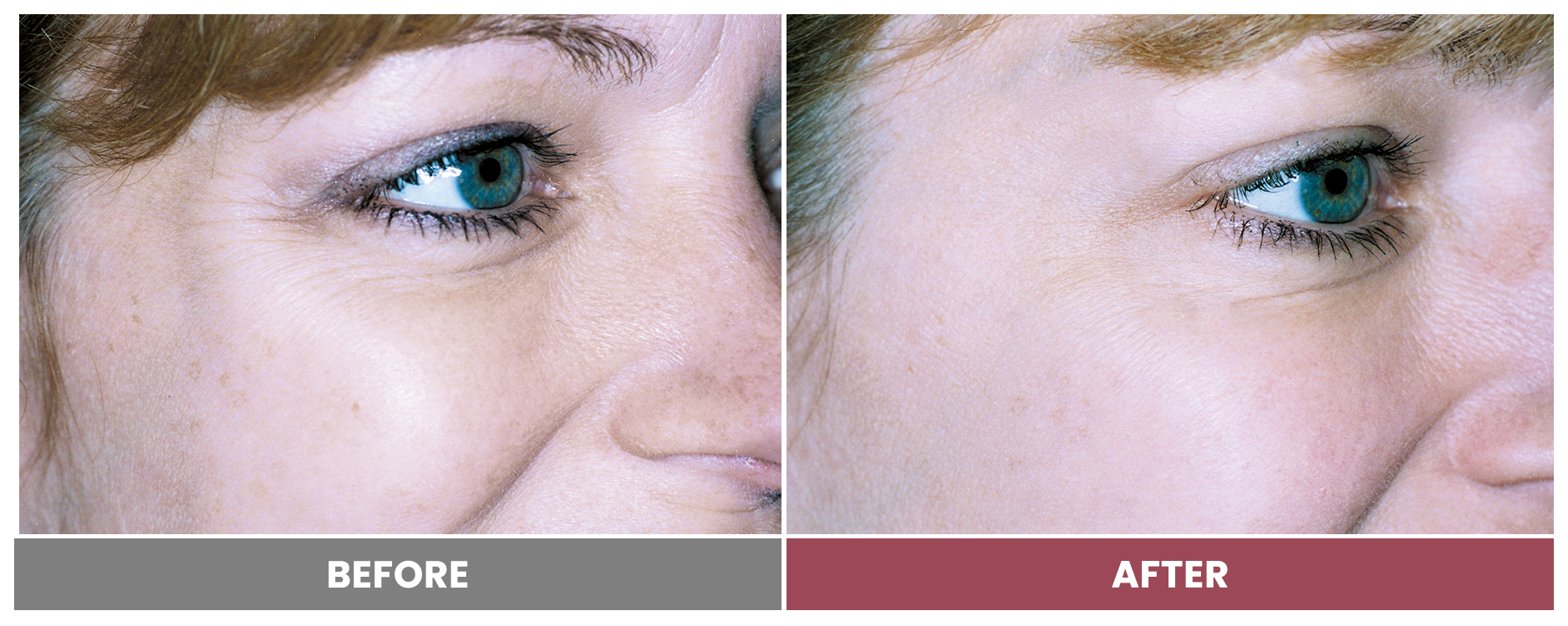 LASER SKIN RESURFACING - Case 5